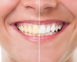 Teeth Whitening in Noida Through Floss Dental Clinic